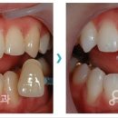 Re:견적문의드려요.[강남연세샘치과 답변입니다*^^*] 이미지