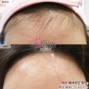 디자인엘앤제이 | 이마라인 정리만 해도 깔끔해보여요. / 헤어라인 왁싱