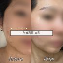 금곡동 피부관리 추천 | 호매실 러블리유 뷰티 여름에도 밝은 피부 가능해요