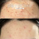 대민약국 | 여드름 피부과 치료 1주차 압출+아그네스+클라리티 제모, 염증주사, 항생제 처방
