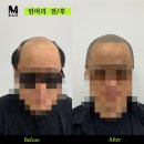 5722 | 탈모로 인한 남자삭발, 민머리 두피문신 후기!