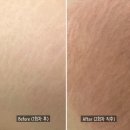 (주)동아메디칼 | 분당 튼살커버 주블링&amp;스킨52 메디컬타투 2회차 리얼 후기