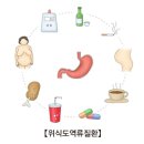 위식도 역류성 질환의 증상과 치료 이미지