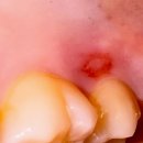 아해한의원 | 인생 첫 사랑니 뺀 썰🦷😬🦷(치아 사진 나옴 주의‼️‼️