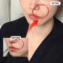 부기 2 | 서울 시청역 피부과 팔자주름 쥬베룩 볼륨 솔직 후기 (통증, 부기, 2주 차 경과)