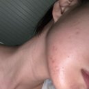 이너뷰티 필라테스 | [여드름] 화장품 좁쌀여드름 화농성 여드름 흉터 없애는 법 이너뷰티 내돈내산