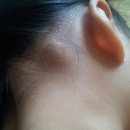 애기 귀 뒷쪽에 갑자기 혹이 생겼어요 이미지