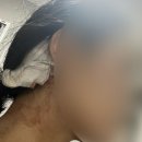 더(The) 스타일난다 | 엠자 이마의 한이 서린, 비절개 모발 이식 1년치 내돈내산 찐 후기 | 강남 히든컷 2300모