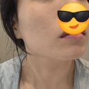 송이한의원 | 목동 편평사마귀 제거 어븀레이저 후기 여름 관리팁