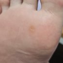 1회 사진기록전 | 발바닥 사마귀 냉동치료 1회차부터 5회차까지의 후기 기록