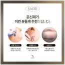 나세르의원 | 타투제거 후기, 레이저 시술 5회 후 차이는?