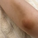 군포산본 팔꿈치 해결! 멜라닌케어 한달 솔직후기(+비포/애프터)