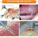 관절통증,관절내시경수술이란? 이미지