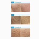 청석한의원 | 부산 서면 [로담한의원] 여드름흉터 치료 첫 상담! 쉽게 적은 솔직 후기♥