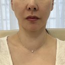 서울엘피부과의원 | 서울 강남역 피부과 덴서티하이 600샷 정품인증과 리투오(Re2O) 줄기세포 후기 가격