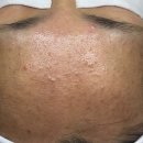 유가메디칼 | 천안 여드름관리 여드름압출 잘하는 에스테틱 | 여드름 재발 없이 졸업 완료