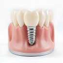 비전치과의원 | 내 치아 인생 리셋 버튼 눌렀다! 연세 굿 프 란 트 치과 방문 후기