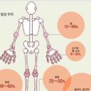 통풍 증상(초기증상) 통풍에 좋은음식 이미지