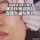 리드뮤즈 | 점빼기 시술후기 | 얼굴 점 제거 2주 변화와 듀오덤·재생크림 관리법