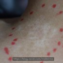 [분당엑시머] 백반증 치료, 표피이식 후기 리뉴미피부과 분당