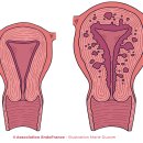 자궁선근증(Adenomyosis;자궁선종) 이미지