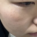 에이치앤에이치 | 광주피부관리 에이치앤에이치더바디 플라즈마 후기