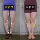 원리비법 | 오다리 교정 12회, 2달 만에 해결한 비법(실제 후기, 사진 영상 포함)