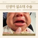 튼튼소아청소년과의원 | [육아] D+23 신생아 설소대 수술 (in 튼튼소아청소년과의원)