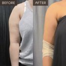 세븐일레븐 천호이편한점 | 천호 비만클리닉 병원 추천 | 팔뚝 슬림 주사 상담 솔직 후기