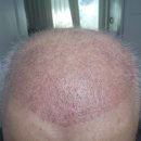 상황 | 터키 모발이식 갔다오고 나서 현재 상황 후기