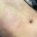 동일산소 | 스쿠버다이빙 감압병(잠수병) 고압산소챔버 치료 후기