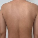 정상한의원 | 광주 서구 피부전문 한의원 : 등 여드름 치료 마지막 후기