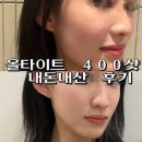 강남역 올타이트리프팅 400샷 얼굴라인 착붙 예비신부 얼굴라인 내돈내산 후기