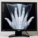 인생플란트치과의원 | 내 치아 인생 바꾼 플란트서울치과의원, 진짜 강추합니다