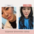 청담동 | 청담동피부과 엘라비에리투오 후기 효과 통증!