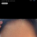 청담비비약국 | 여드름, 여드름 전문 에스테틱 더록시 강남점 논현점 청담점 후기/ 더록시 강필 탈각/ 더록시 체험가...