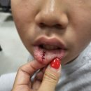한림대 동탄성심병원 초등아이 입안 점액낭종 치료 수술후기