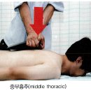 (치료)Thoracic prone Bilateral facet Seperation(wedge이용 2가지방법) 이미지