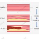 협심증 나타나는 이유, 방안은??? 이미지