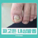 엠허브메디컬센터 맞은편 | 현풍 내성발톱 때문에 한발짝 떼기로 어려웠던...