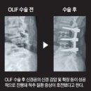 허리 통증·다리 저림 무서워 '척추관협착증' 수술 망설인다면… 이미지