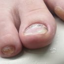 덕양의원 | 덕양구 지축 내성발톱 병원 추천! 발톱 말림 교정 치료 받고 온 후기