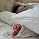 자연치유 | 아기 얼굴 혈관종 진료 후기 (강원대병원 / 자연치유? 치료 방법까지)