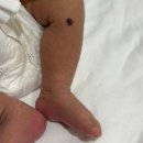 지니성형외과의원 | 선천성 멜라닌세포 모반 수술 상담 후기｜대구 닥터지니 성형외과의원 예약부터 수술까지 (아기 큰점 제거)