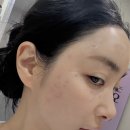 몽돈 | [공지] 편평사마귀 1개당 1,100원 제거 후기 내돈내산