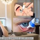 눈다래끼 원인 증상 치료 빨리낫는법 다래끼 약 안연고 이미지