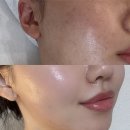 콜드플라즈마 | 여의도피부관리 여드름피부 콜드플라즈마 후기 에이스킨