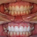 김현주치과의원 | 미백제, 미백치약 효과 있을까 최초 부산 미니쉬 치과 원장이 알려주는 미백 제품 효과