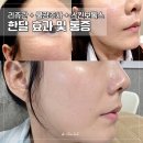 샤인피부미용 | 대전 유성구 피부과 더마샤인 리쥬란 스킨부스터 + 물광주사 + 스킨보톡스 잘하는 곳 ： 효과 및 통증