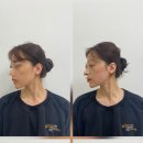 렌즈맨천안점 | 천안 비대칭 교정 아나토미 에스테틱 천안점 | 얼굴 비대칭교정, 윤곽관리 후기